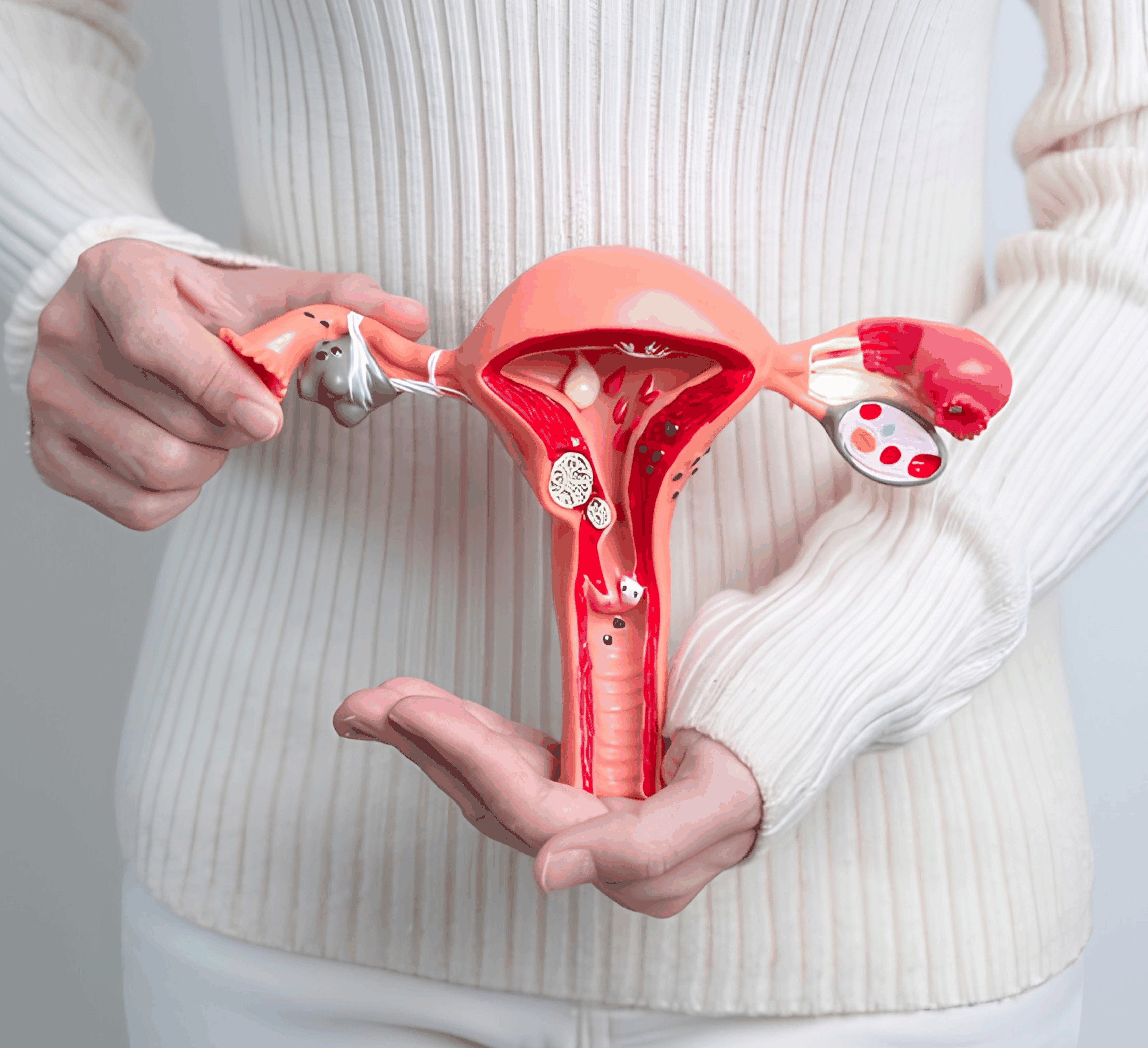 Endometriosis