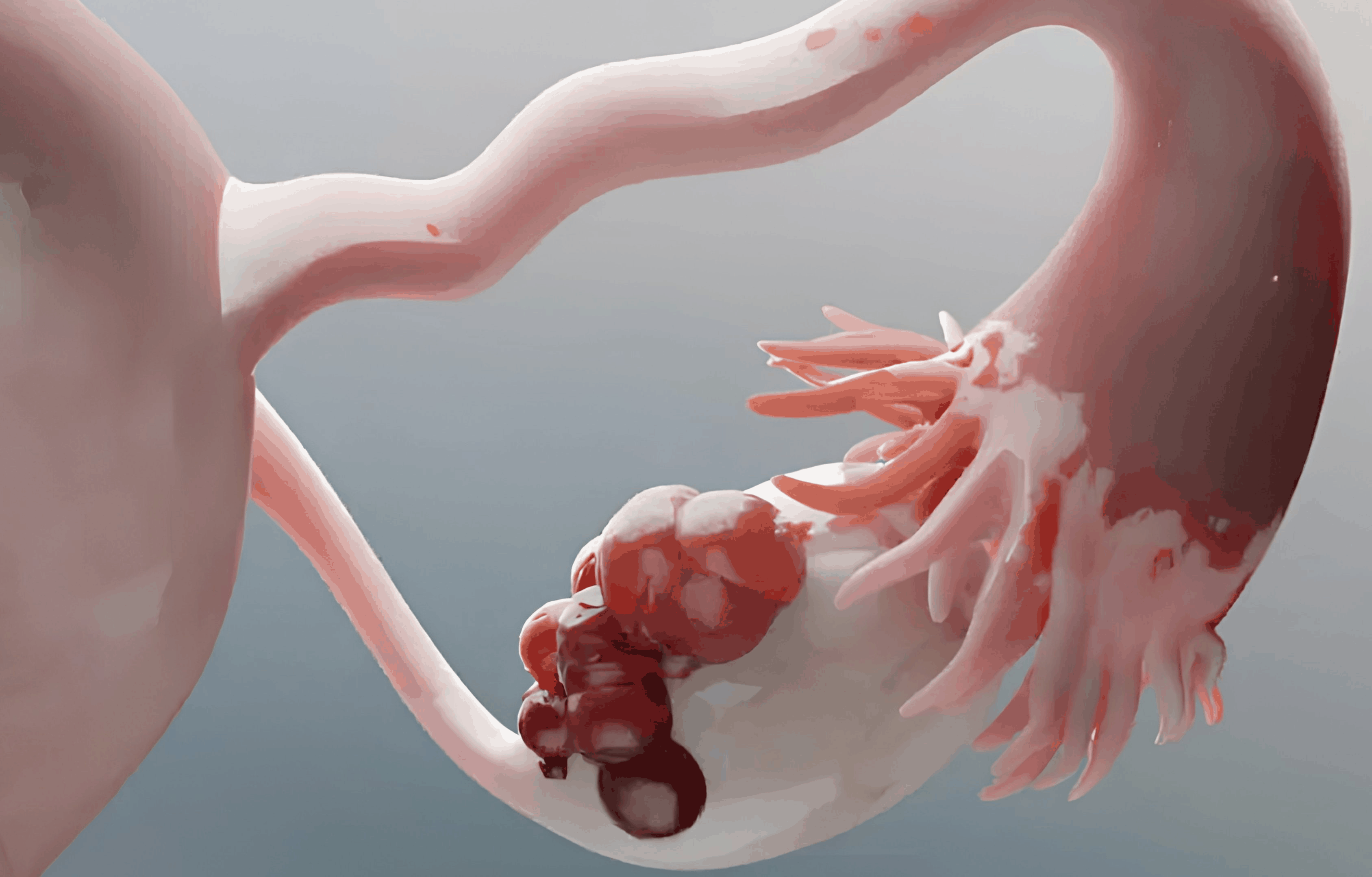 Ovarian Cyst Removal